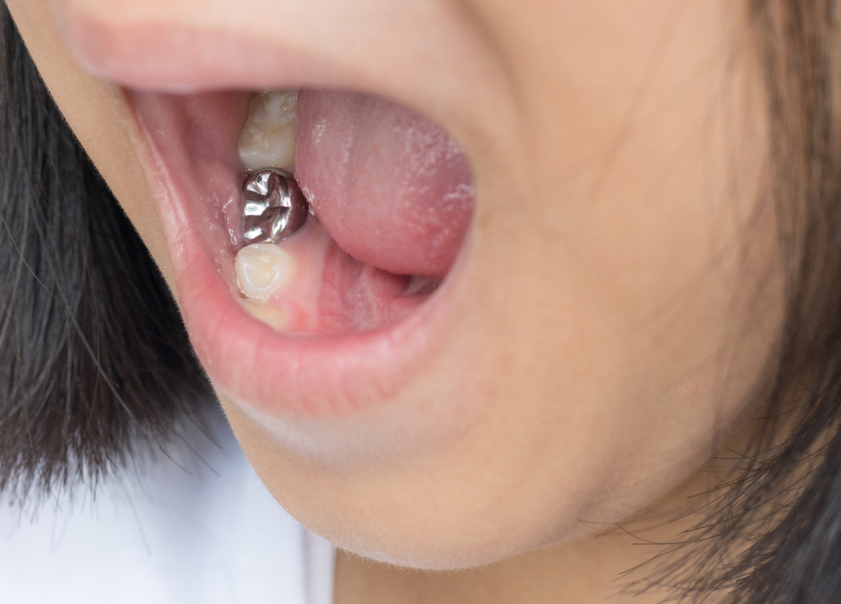 What Are Silver Fillings?