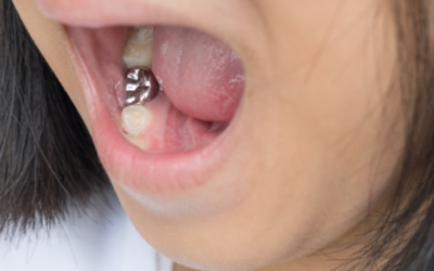 What Are Silver Fillings?
